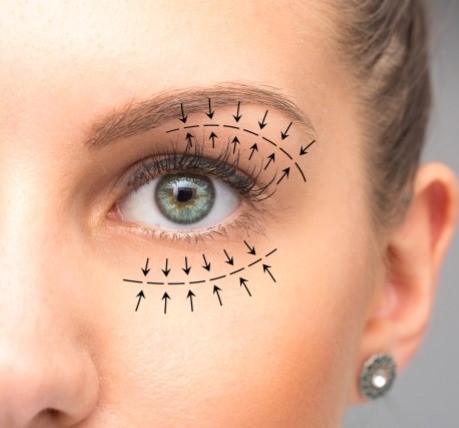 Blepharoplasty-Laser blepharoplasty