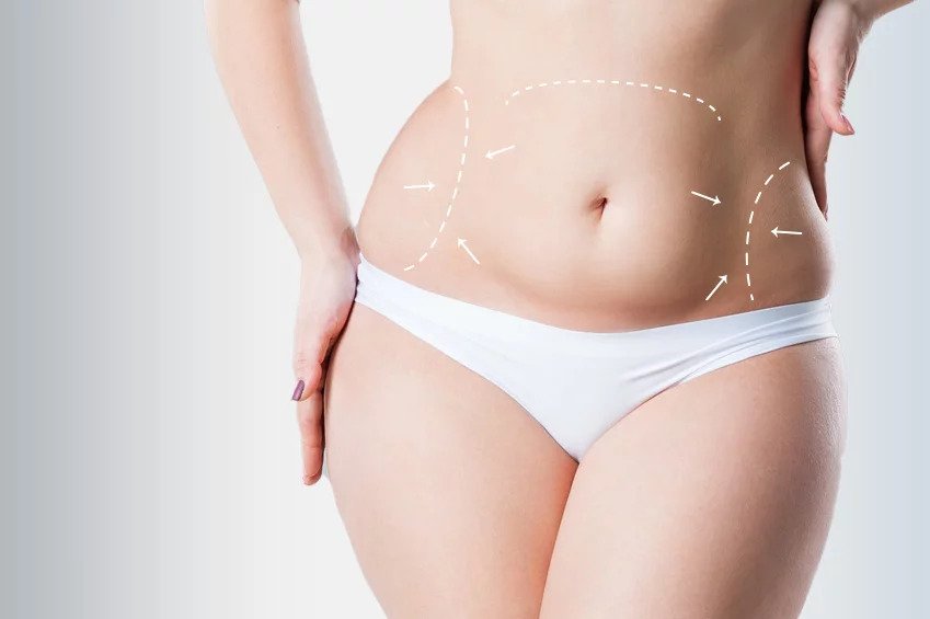 Abdominoplasty (tummy tuck)